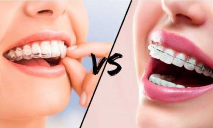 Braces and clear aligners