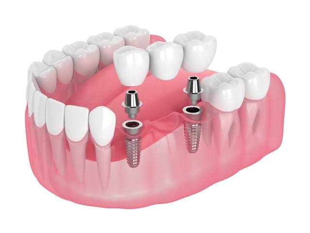 Dental implants