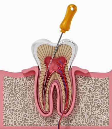 Root canal treatment