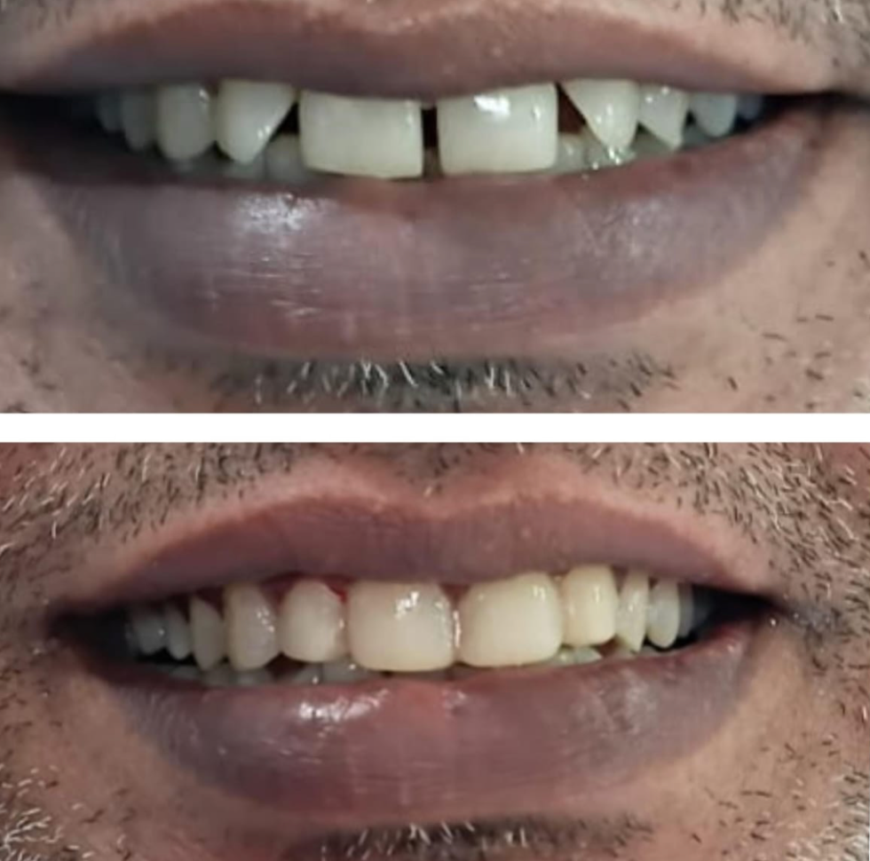 Real patient smile transformation result at Dr. Ahmad's clinic