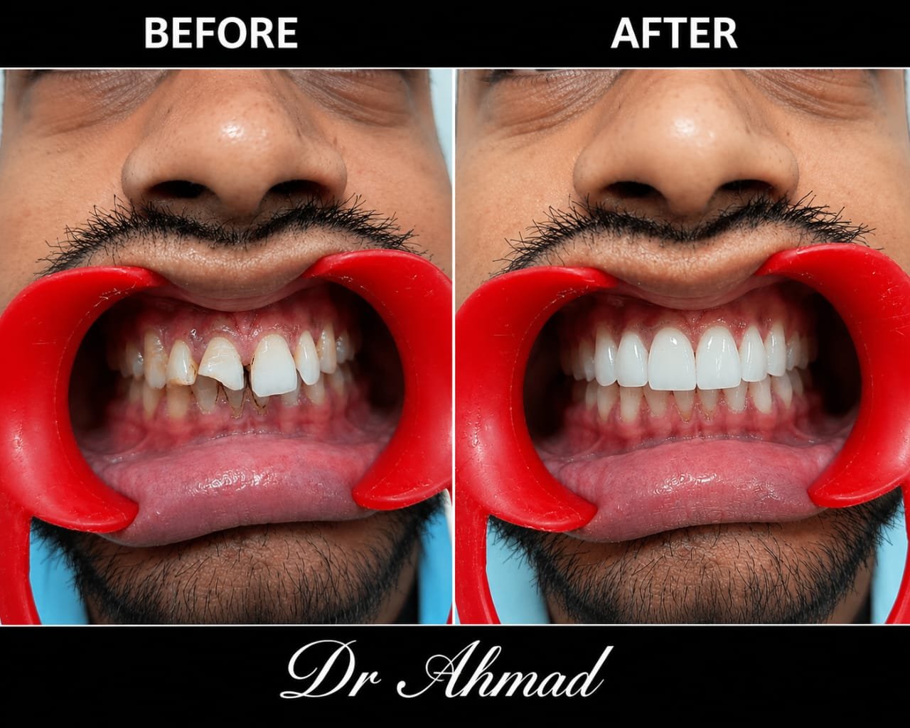 Real patient smile correction after traumatic teeth injury at Dr. Ahmad's clinic