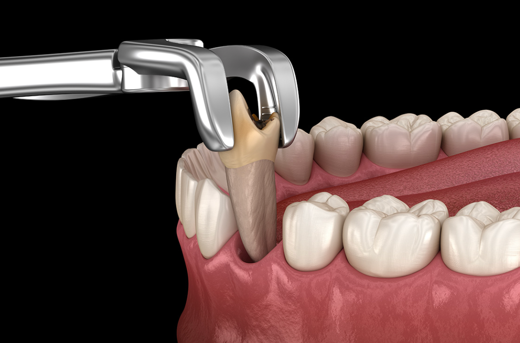 Extractions