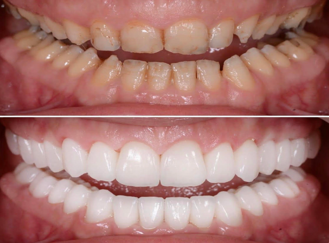 Full mouth rehabilitation