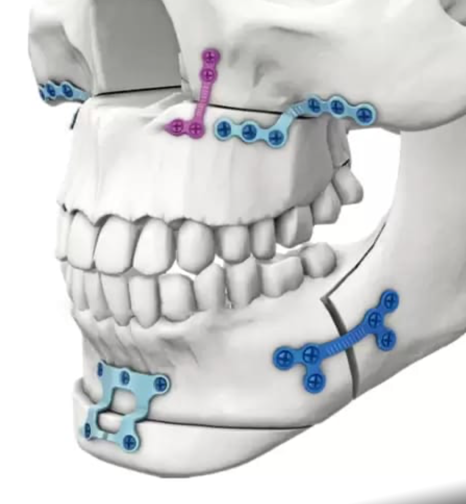 Jaw fracture treatment