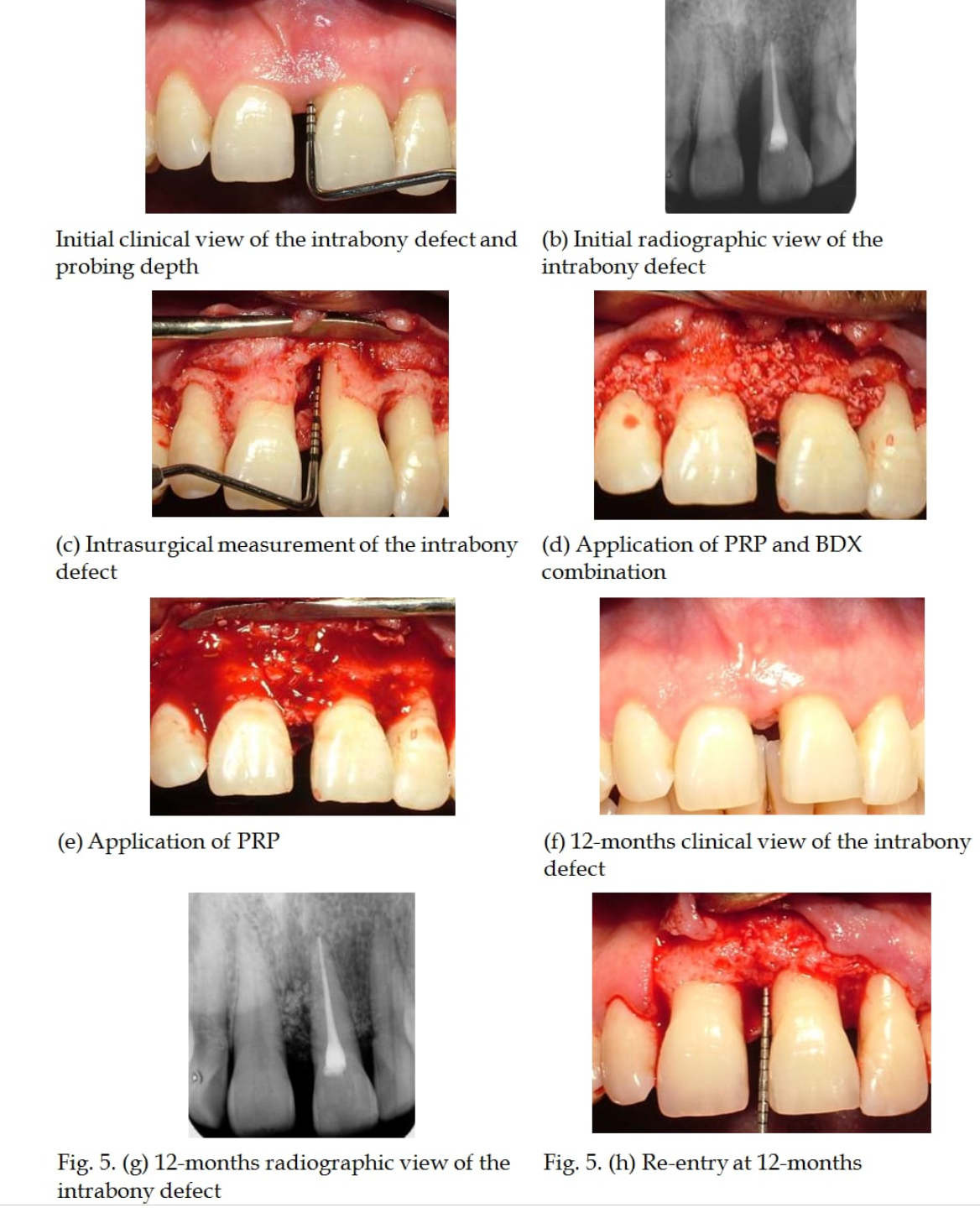 PRP treatment for gum disease