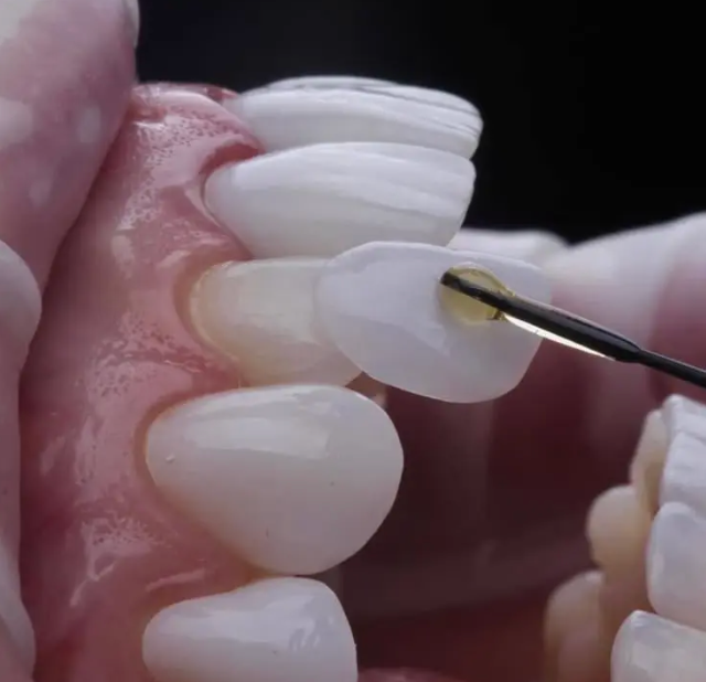 Veneers