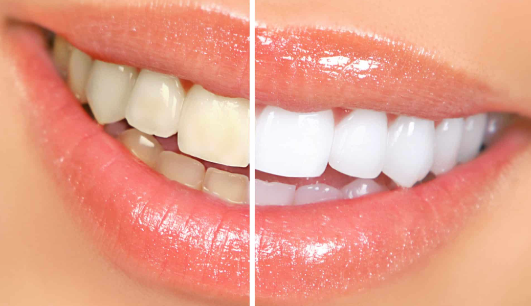 Teeth whitening
